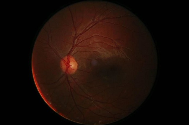 Hình ảnh minh họa ý nghĩa của từ optic nerve