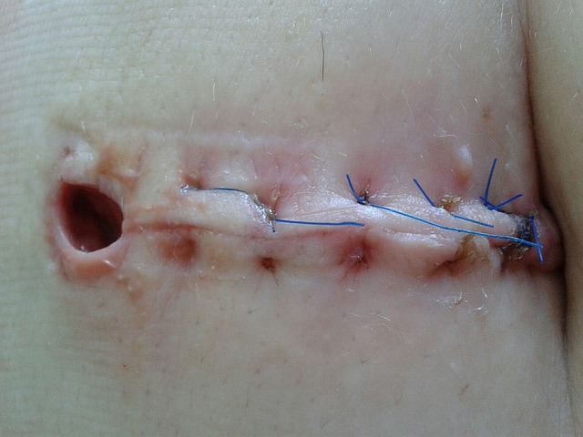 scar tissue